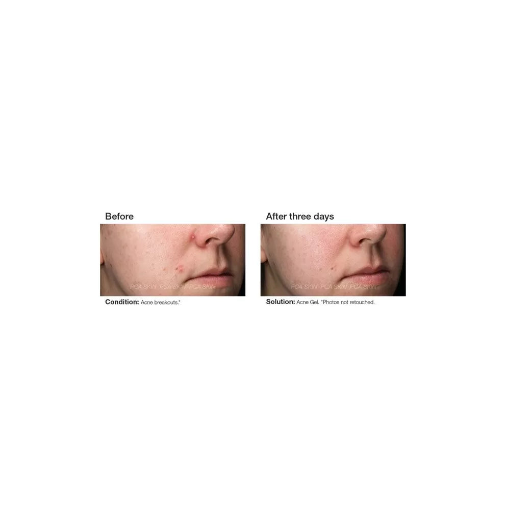 PCA Skin Acne Gel 30ml