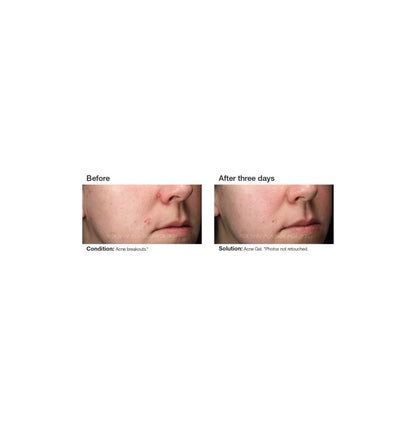 PCA Skin Acne Gel 30ml