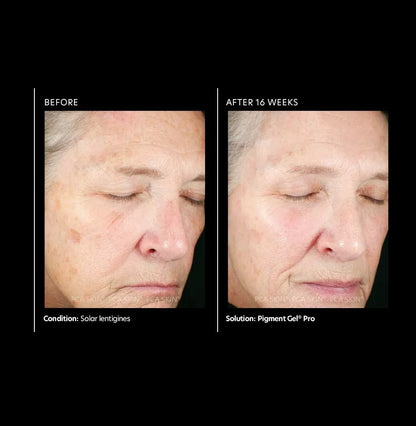 PCA Skin Pigment Gel Pro 29ml