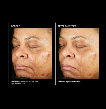 PCA Skin Pigment Gel Pro 29ml