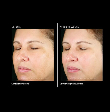 PCA Skin Pigment Gel Pro 29ml