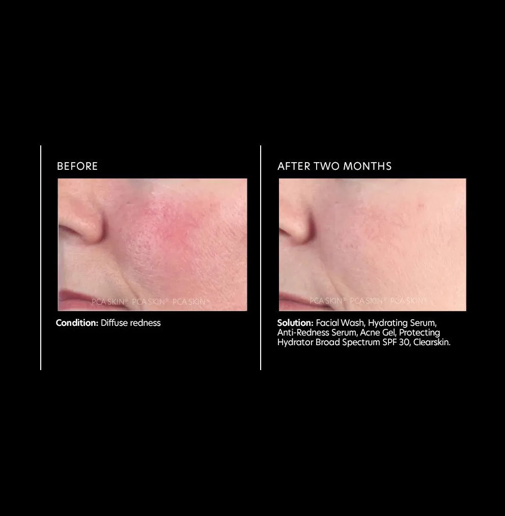 PCA Skin Anti-Redness Serum Anti-Redness Serum 30ml