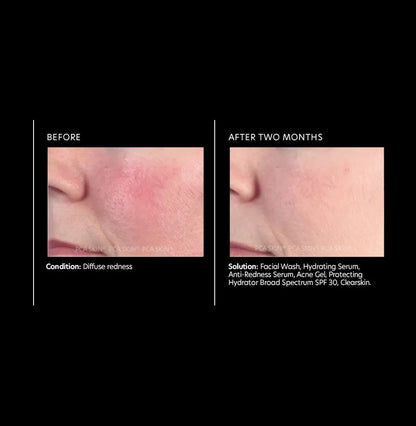 PCA Skin Anti-Redness Serum Anti-Redness Serum 30ml